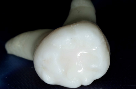 Zahnarzt Bochum: der versiegelte Zahn