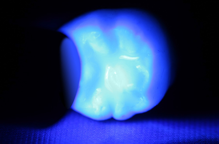 Zahnarzut Herne: Aushärten mit der Polymerisationslampe