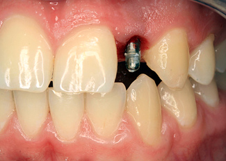 Zahnarzt Bochum Implantologie